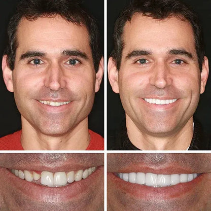 Ends Today: 60% OFF! ⏰Custom-Fit Instant Smile Dentures – Natural Looking Comfort Fit