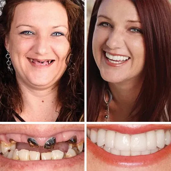 Ends Today: 60% OFF! ⏰Custom-Fit Instant Smile Dentures – Natural Looking Comfort Fit